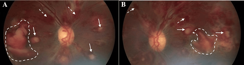 Cureus | Leukemic Retinopathy: A Diagnostic Clue for Initial Detection ...