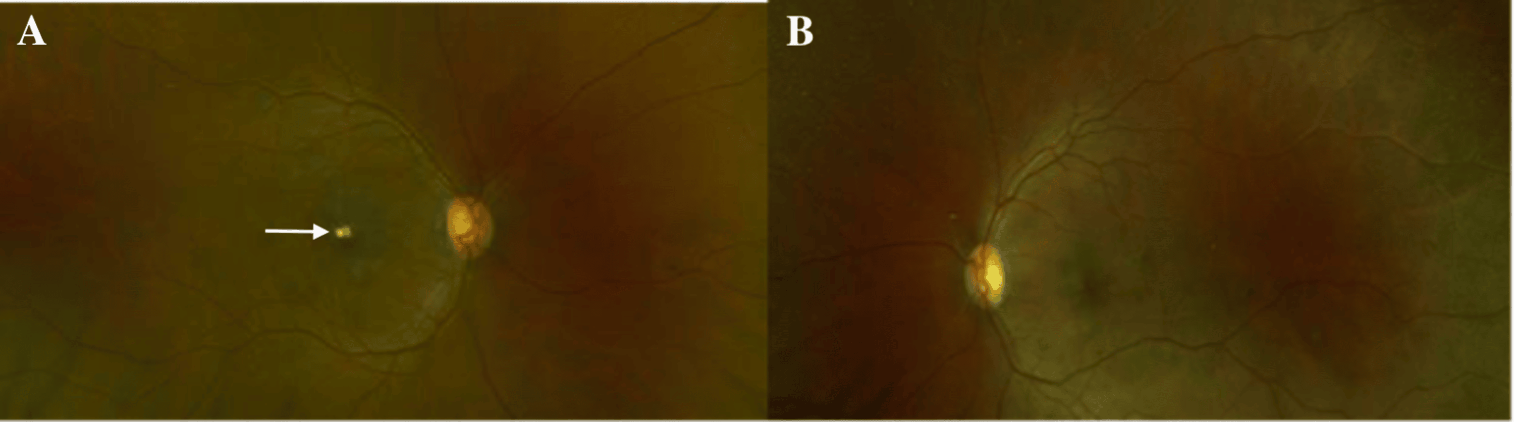 Cureus | Leukemic Retinopathy: A Diagnostic Clue for Initial Detection ...