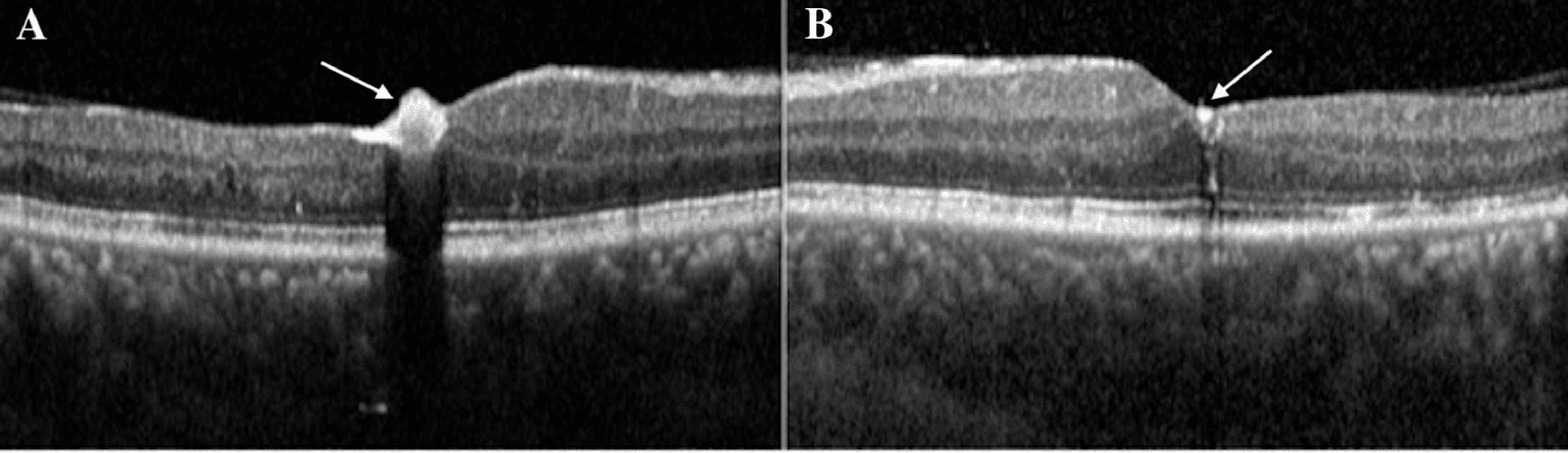 Cureus | Leukemic Retinopathy: A Diagnostic Clue for Initial Detection ...