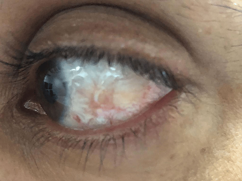 Treatment Of Steroid Resistant Nodular Episcleritis With Tacrolimus A