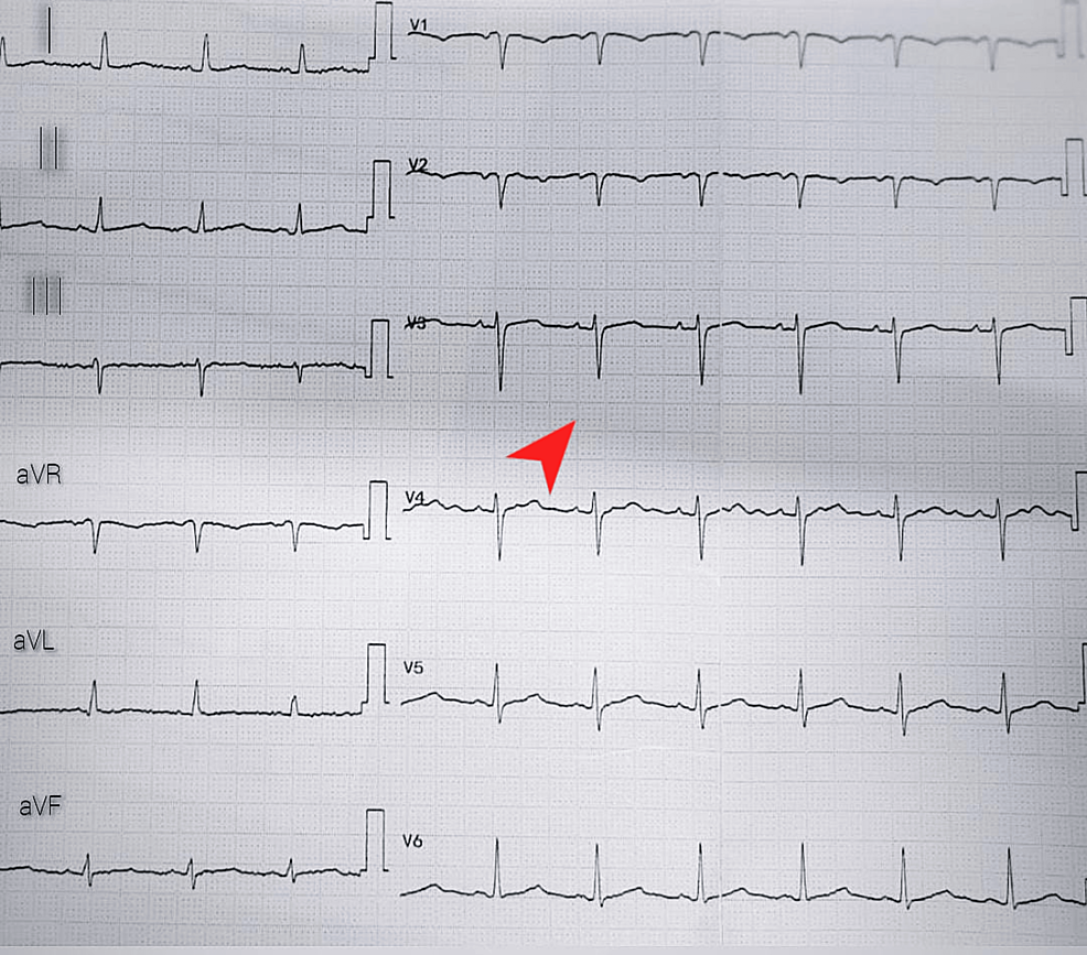 Cureus Postcardiac Injury Syndrome in a Systemic Lupus Erythematosus