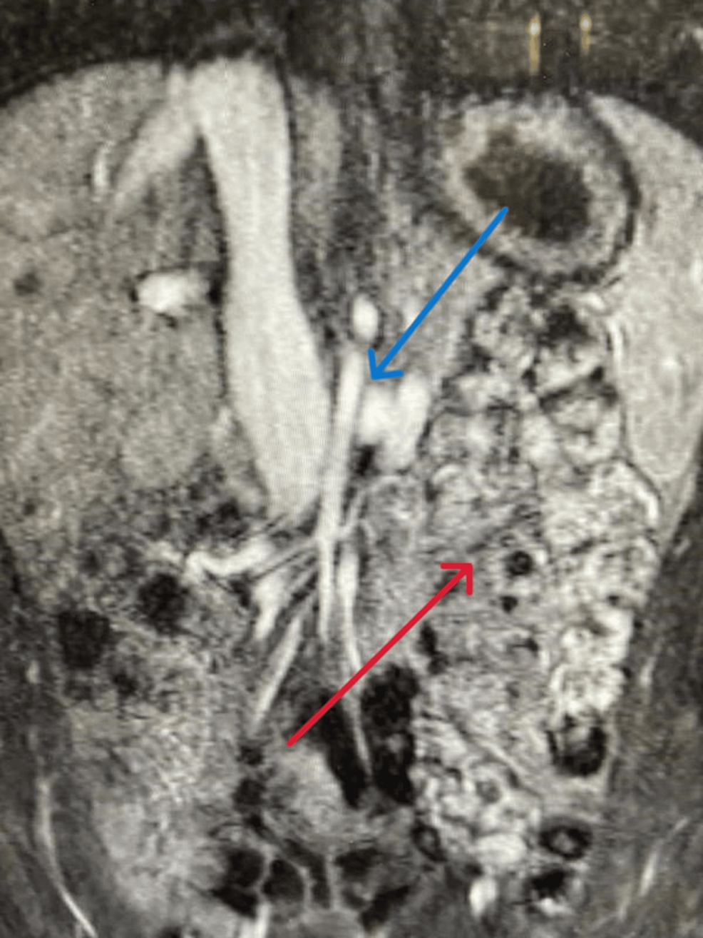 A Rare Case of Nutcracker Phenomenon Associated With Midgut Malrotation