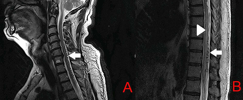 T2-MRI-of-the-cervical-spine-(A)-and-thoracic-spine-(B)