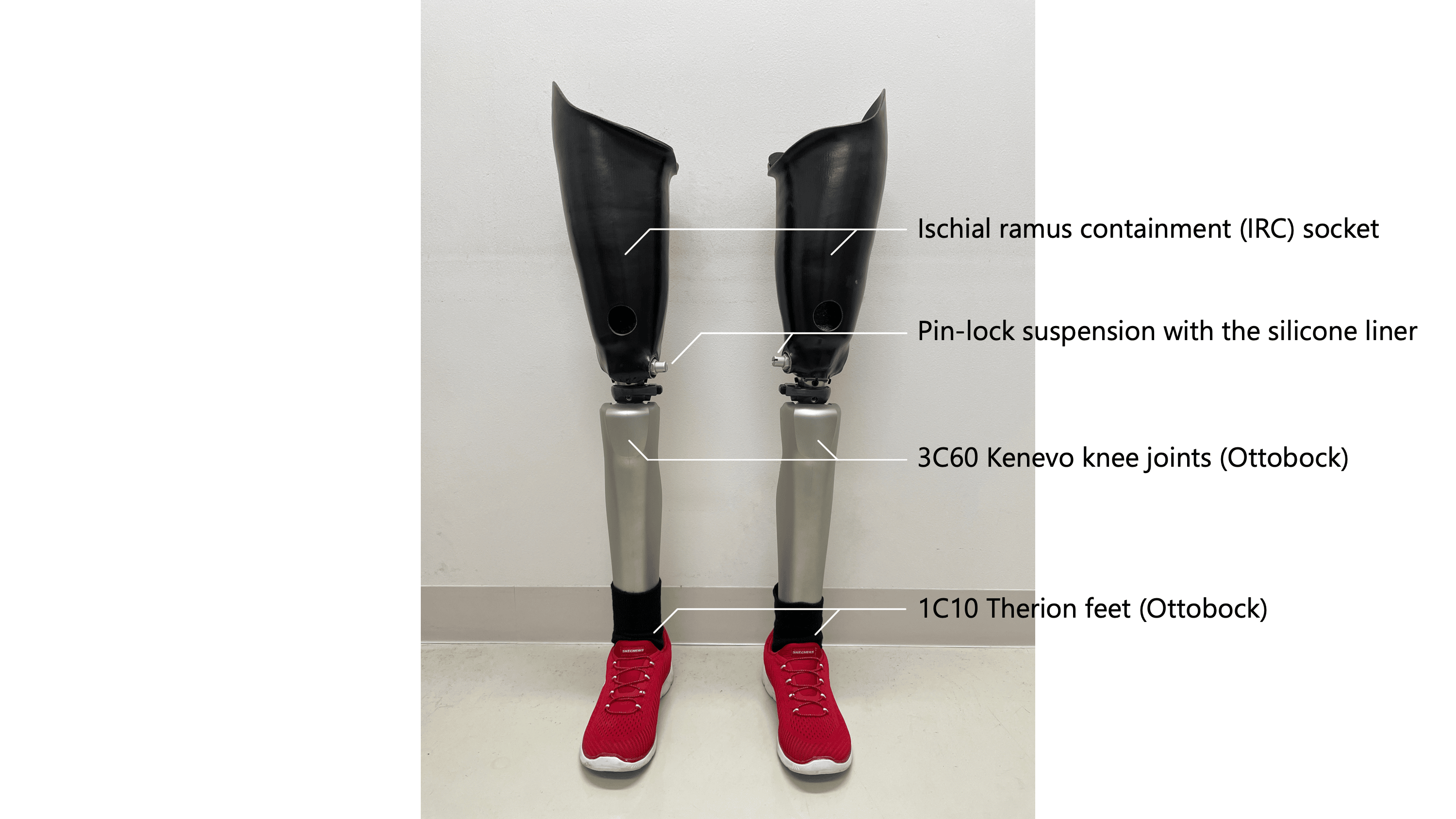 Prosthetic Rehabilitation Of A Female With Bilateral Transfemoral ...