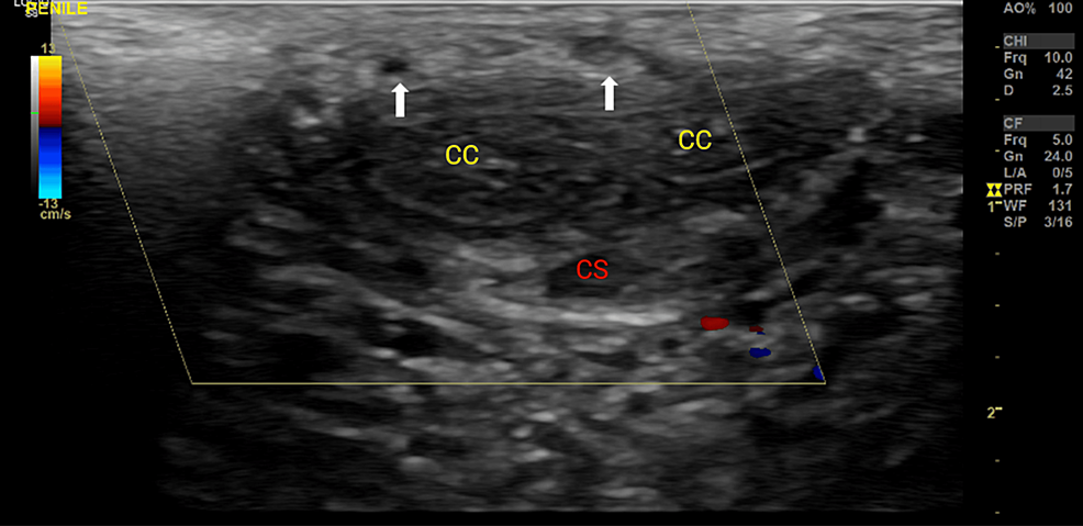 Cureus Penile Mondor s Disease Resulting From Forceful Condom