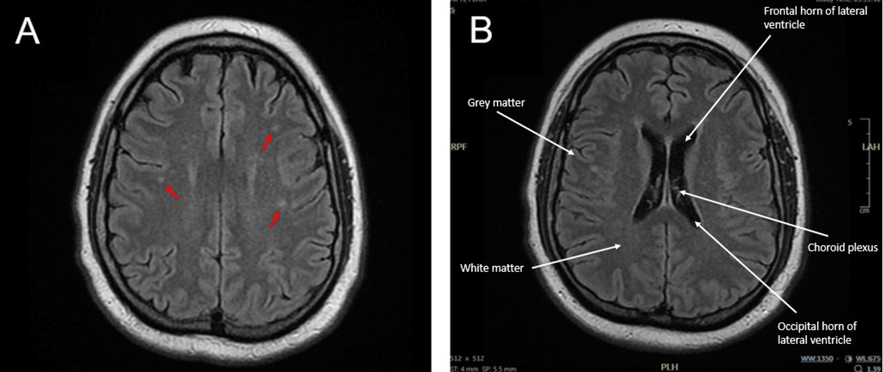 Cureus | An Incidental Diagnosis of Neurosyphilis: A Case Report