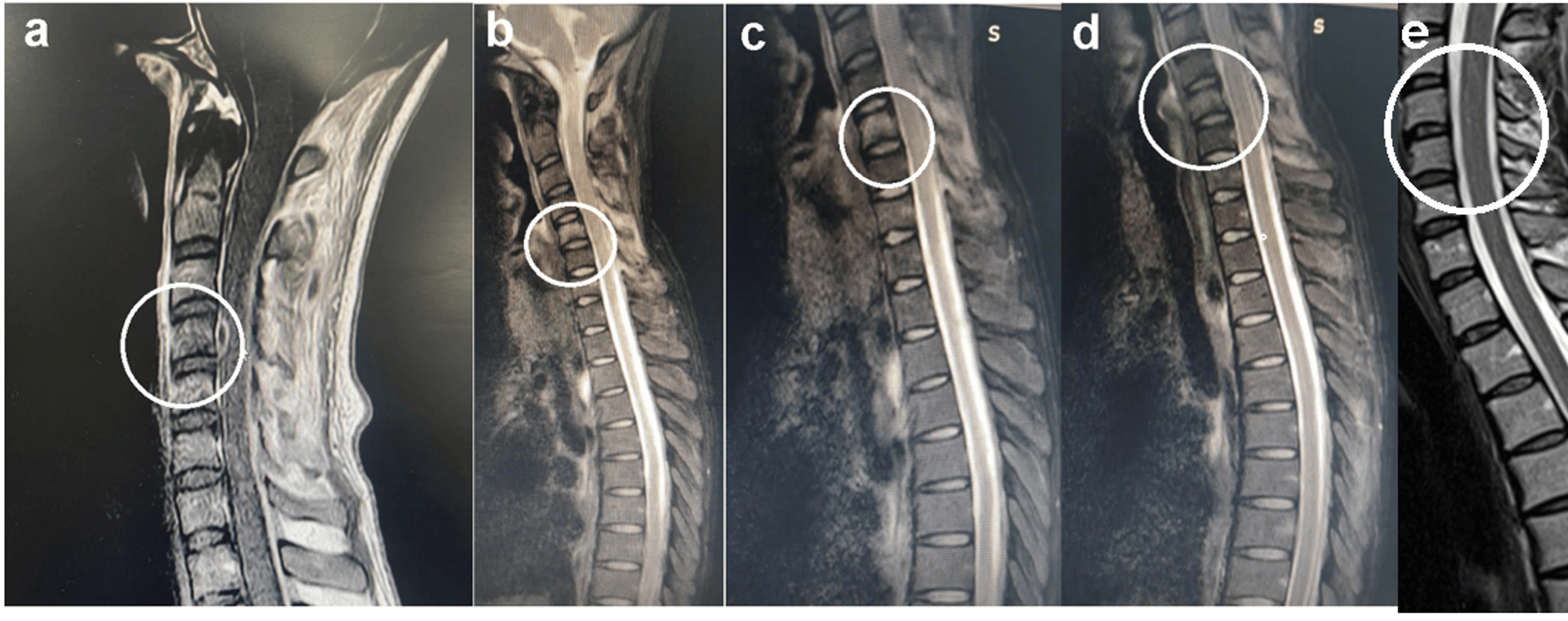 Cervical Pott’s Disease Presenting As Quadriplegia in a Young Patient