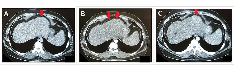 -Pre-TACE-Triphasic-CT-abdomen-showing-plain-(A),-arterial-(B),-and-venous-(C)-phases-of-study