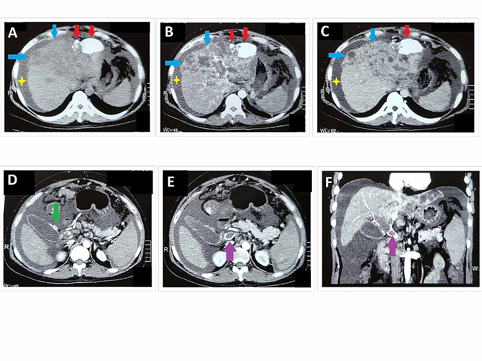 Two-months-post-TACE-triphasic-CT-abdomen-showing-plain-(A),-arterial-(B),-and-venous-(C)-phases-of-the-study
