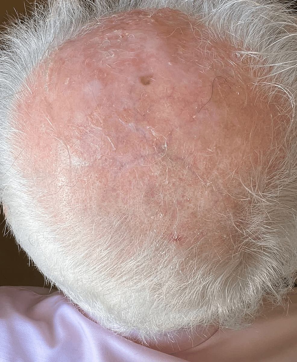 Erosive Pustular Dermatosis of the Scalp in a Patient With Vitiligo
