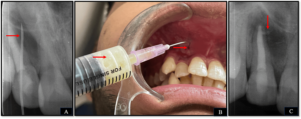 Cureus | pioneering periapical healing: the novel synergy of mineral