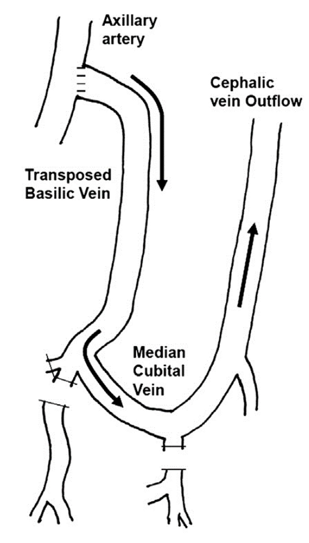 Operative Techniques to Prevent Dialysis Access-associated Steal ...