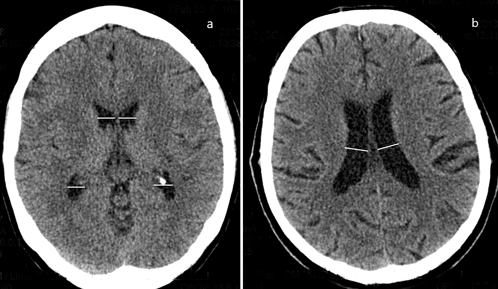 Cureus The Anatomic Variability Of The Lateral Ventricles Of The Human Brain Depending On Age 2682