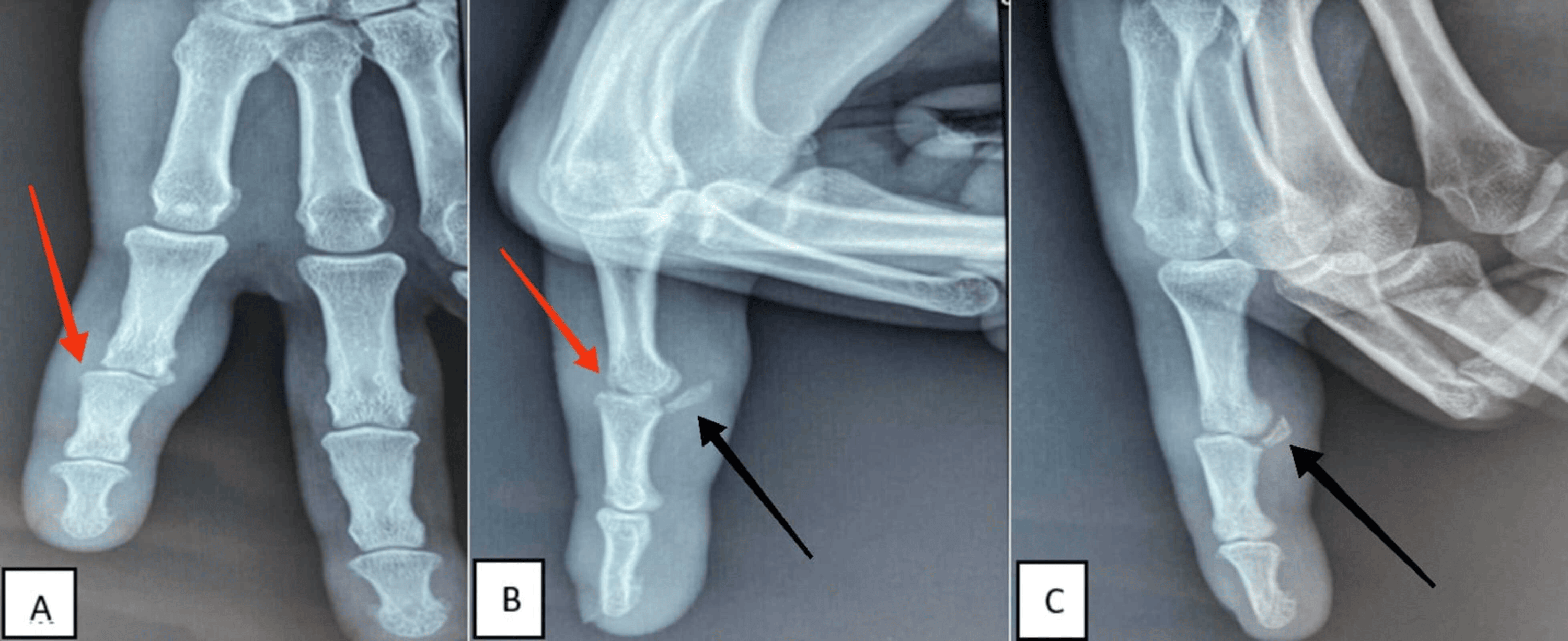 Cureus Fracture Dislocation Dorsal Of The Proximal Interphalangeal