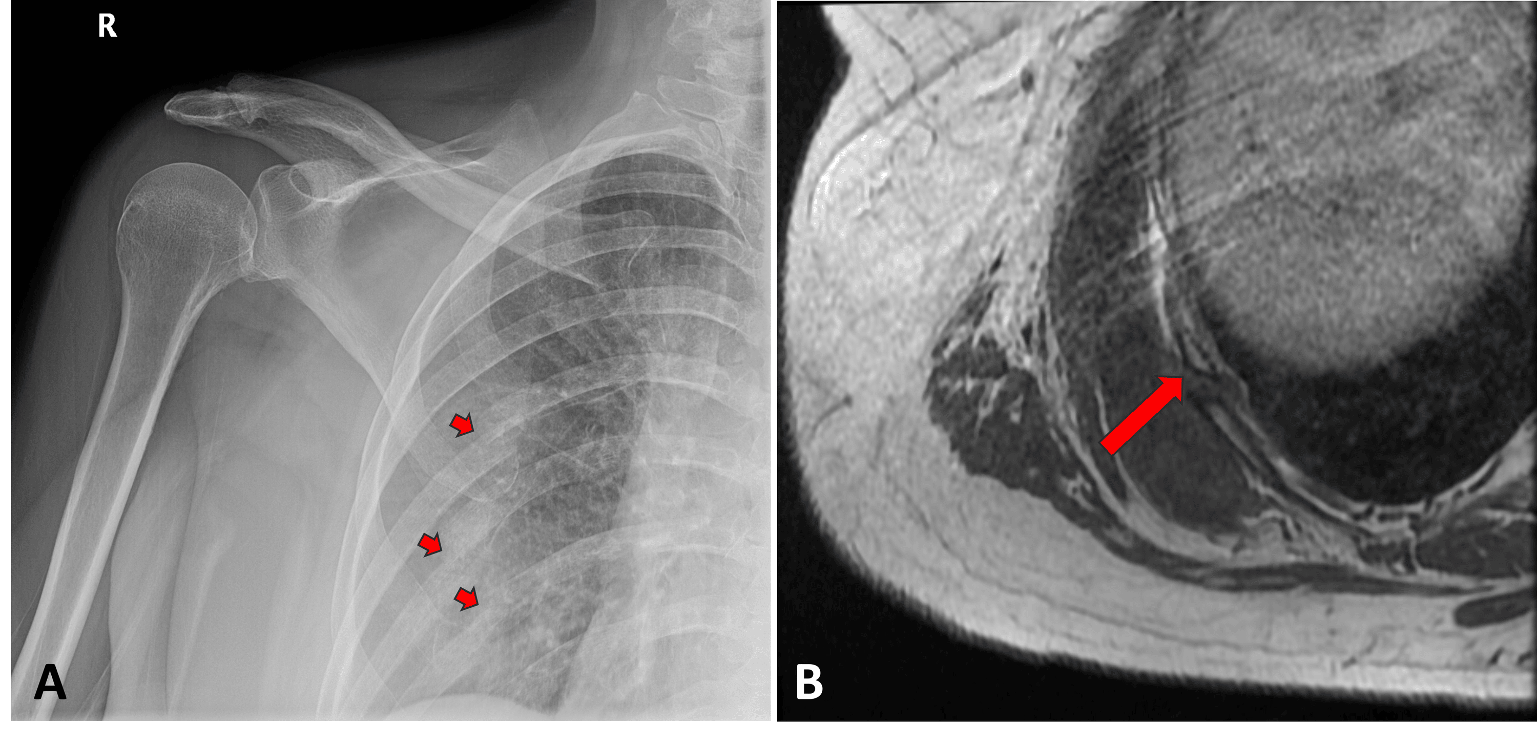 Rib Fragility Fractures And Chest Wall Hematoma After Cardiopulmonary Resuscitation Training A