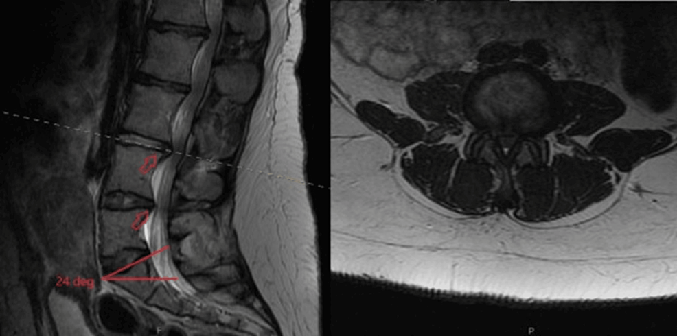 Lumbar Spinal Stenosis - Oxford Spine & Neuro