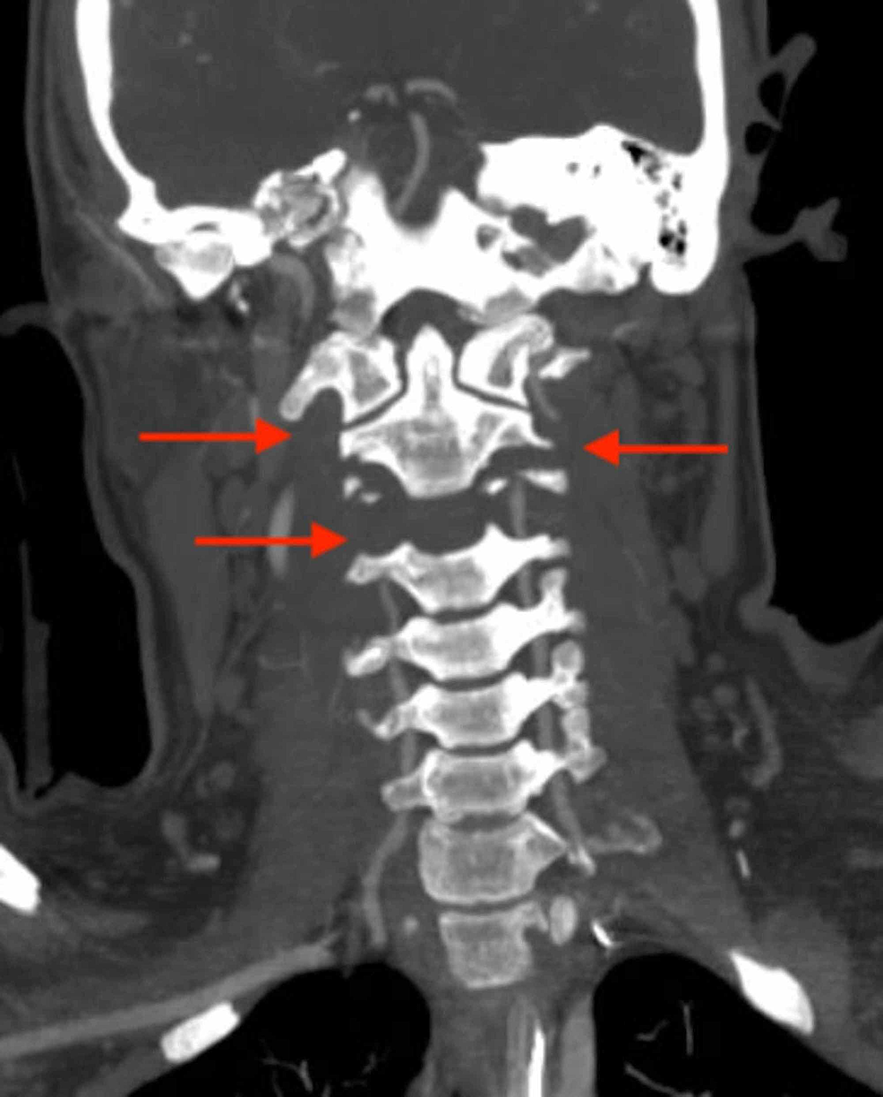 CT-angiography-of-the-cervical-spine:-coronal-view-red-arrows-show-bilateral-vertebral-artery-injury-at-the-level-of-C2.