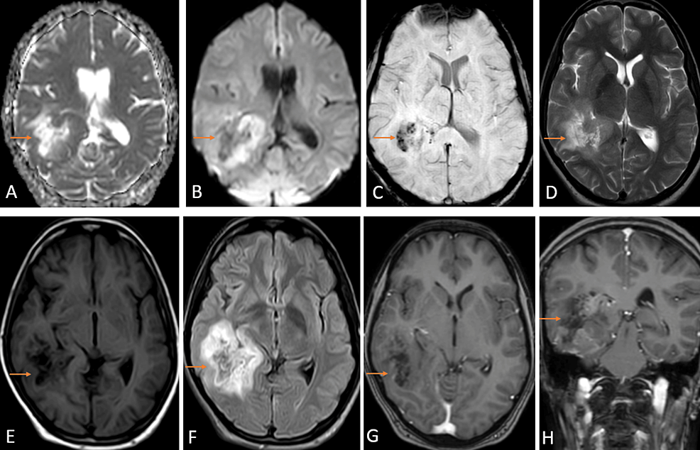 Case Report: Grade 1 Astrocytoma in a Female from Rural India, as diagnosed by the World Health Organization (WHO)