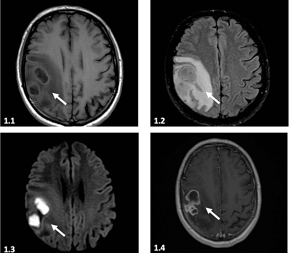 Cureus Cerebral Abscess Due to Nocardia beijingensis Associated With HIV Case Report and Mini