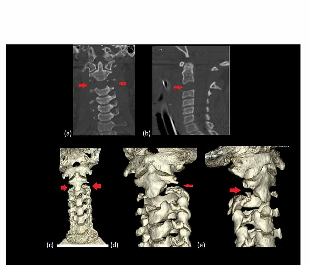 CT-of-the-cervical-spine:-(a)-coronal,-(b)-sagittal,-(c)-CT-3D-reconstruction-(d)-and-(e)-3D-oblique-view.-All-views-with-red-arrows-show-cranial-caudal-dislocation-of-C2-on-C3.