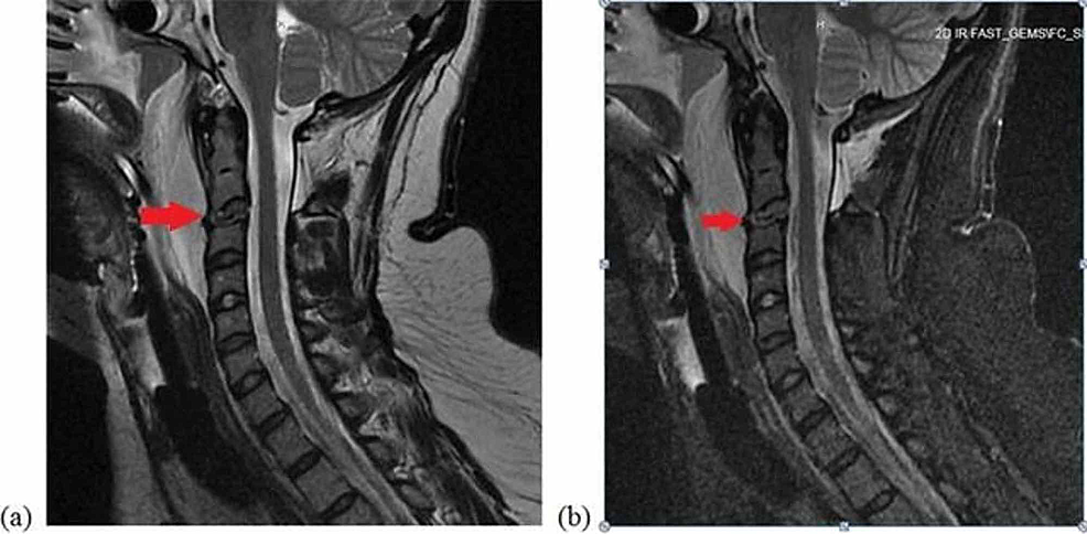 MRI-of-the-cervical-spine.-(a)-T2-Weighted-sagittal-view-and-(b)-STIR-sagittal-view-of-the-cervical-spine-with-red-arrows-show-C2-3-intervertebral-disc-injury.