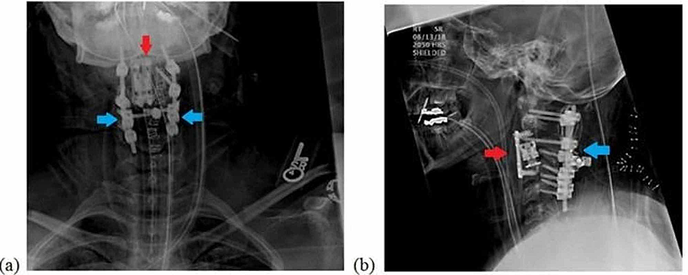 Postoperative-cervical-radiographs:-(a)-AP-view-and-(b)-lateral-view-with-red-arrows-show-a-12-mm-vertebral-body-replacement-cage-was-placed-and-a-26-mm-anterior-plate-and-blue-arrows-showing-posterior-instrumentation-of-C1-C4-with-sublaminar-wiring-between-C1-and-C2.
