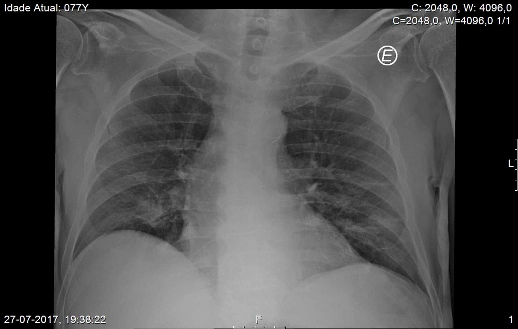 Cureus | Disseminated Nocardiosis: A Case Report