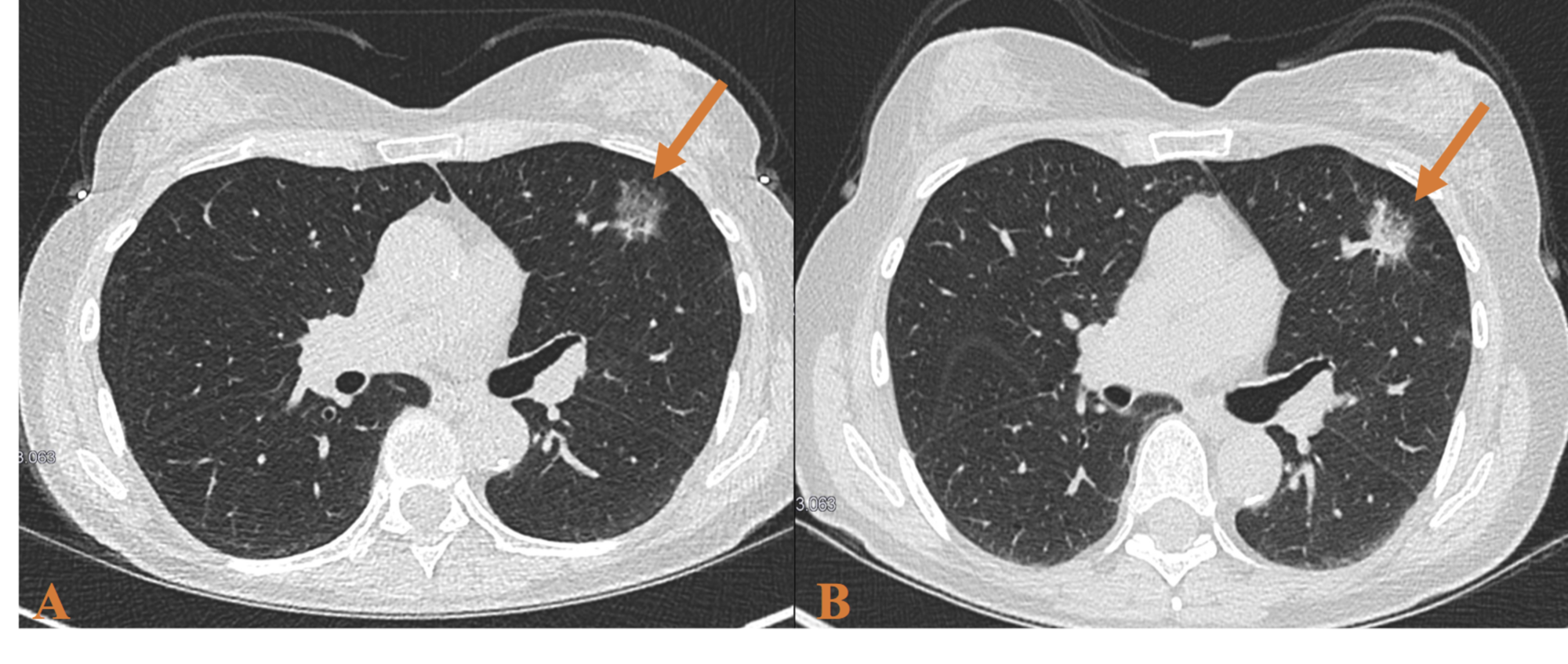 Cureus Pulmonary Atypical Adenomatous Hyperplasia Diagnostic and