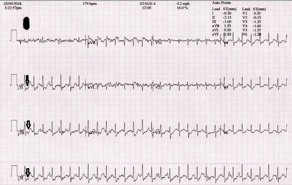 When the Heart Cries Wolf: Myocardial Bridging Presenting as Angina-like Chest Pain