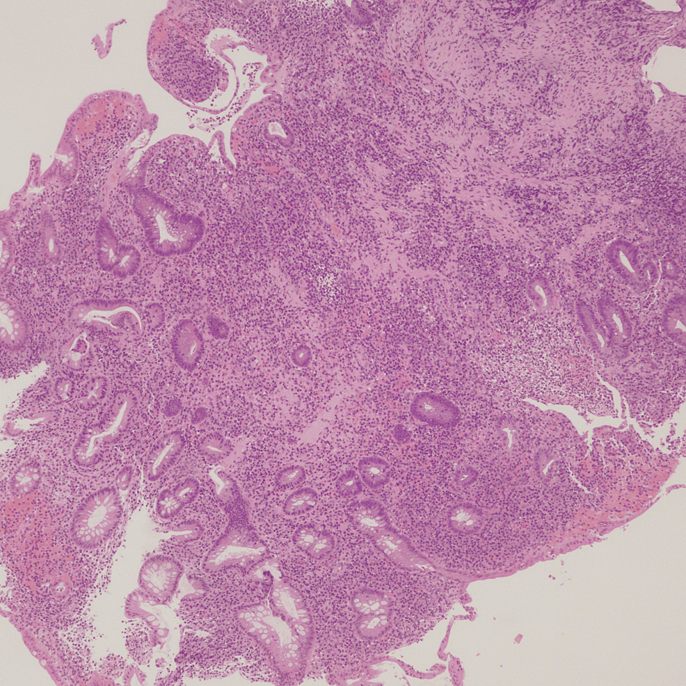 cureus-ulcerative-colitis-flare-post-isotretinoin-use-a-case-report