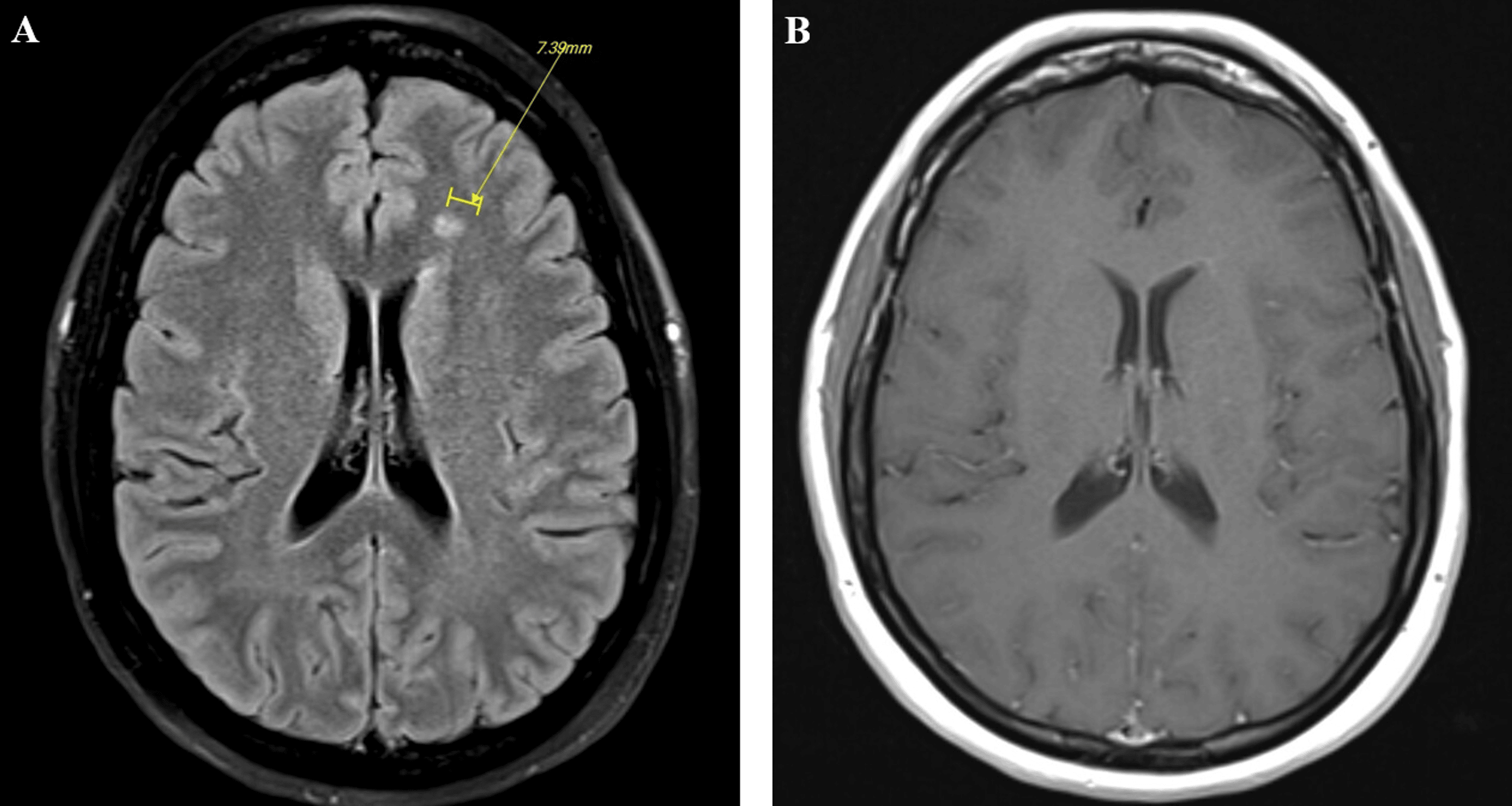 Longitudinally Extensive Transverse Myelitis in a Patient With Systemic ...