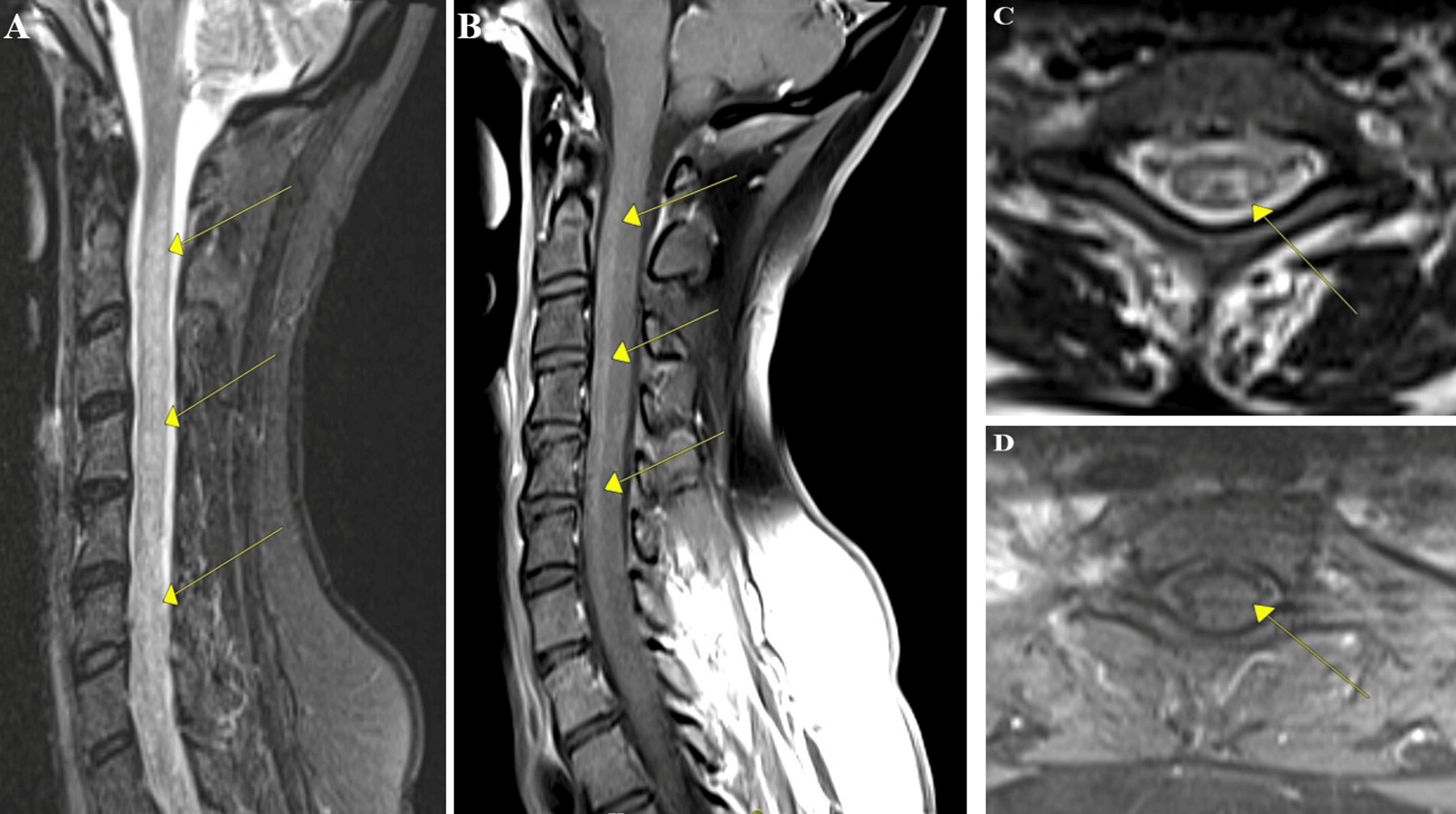 Longitudinally Extensive Transverse Myelitis in a Patient With Systemic ...