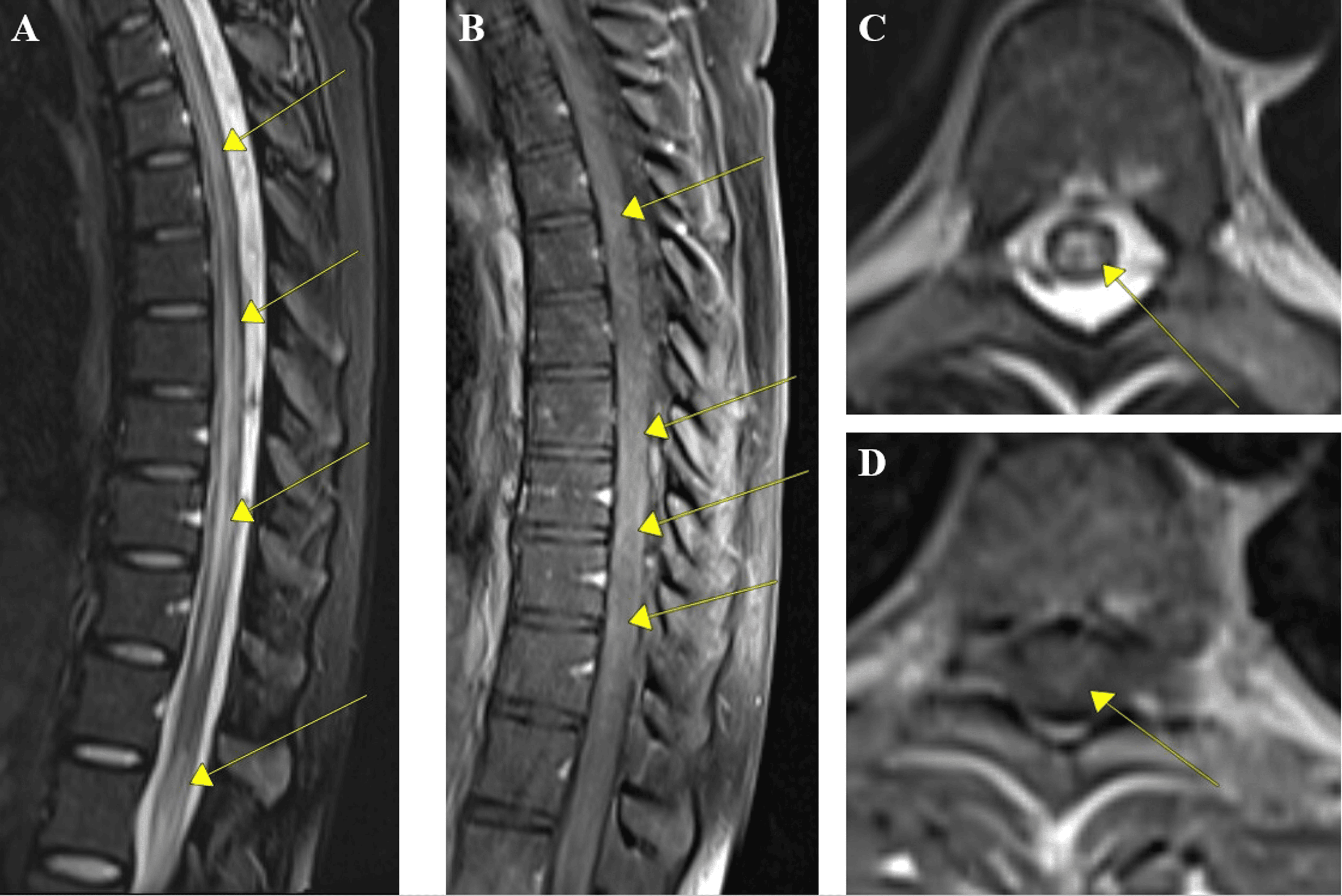 Longitudinally Extensive Transverse Myelitis in a Patient With Systemic ...