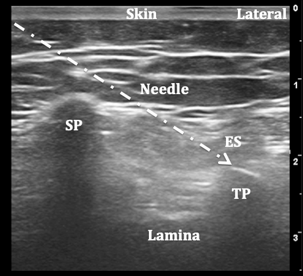 Cureus | Defining the Indications and Levels of Erector Spinae Plane ...