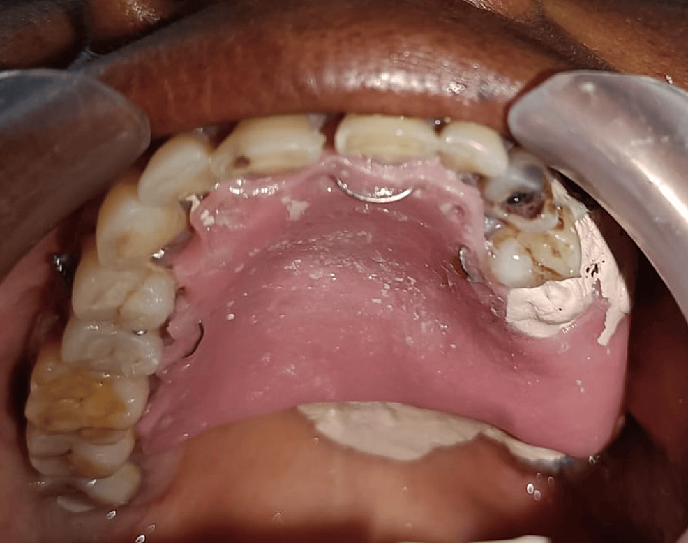 Cureus CementoOssifying Fibroid Epulis in the Posterior Maxilla