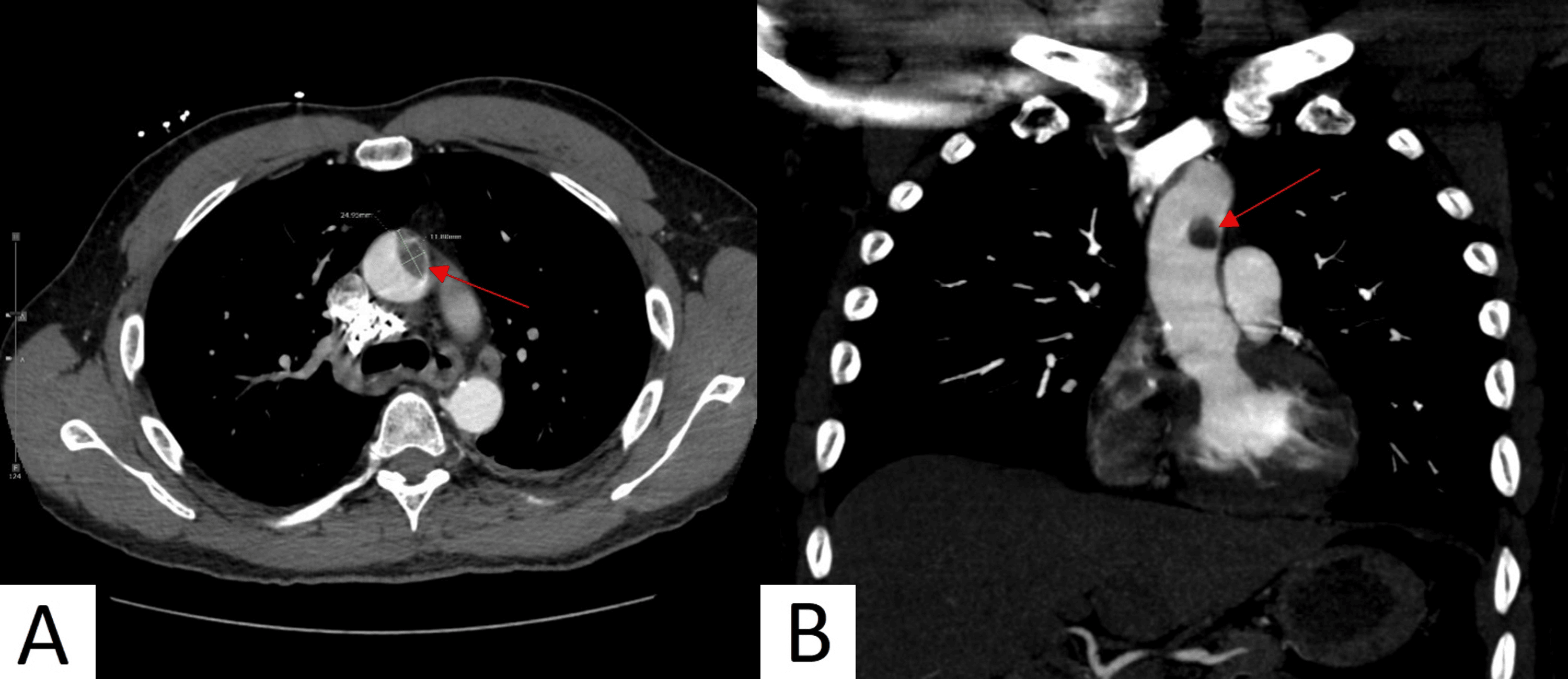 CocaineInduced Ascending Aortic Thrombus Cureus