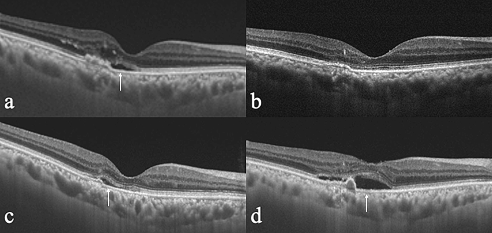 Characteristics Of Eyes With Neovascular Age-Related Macular ...