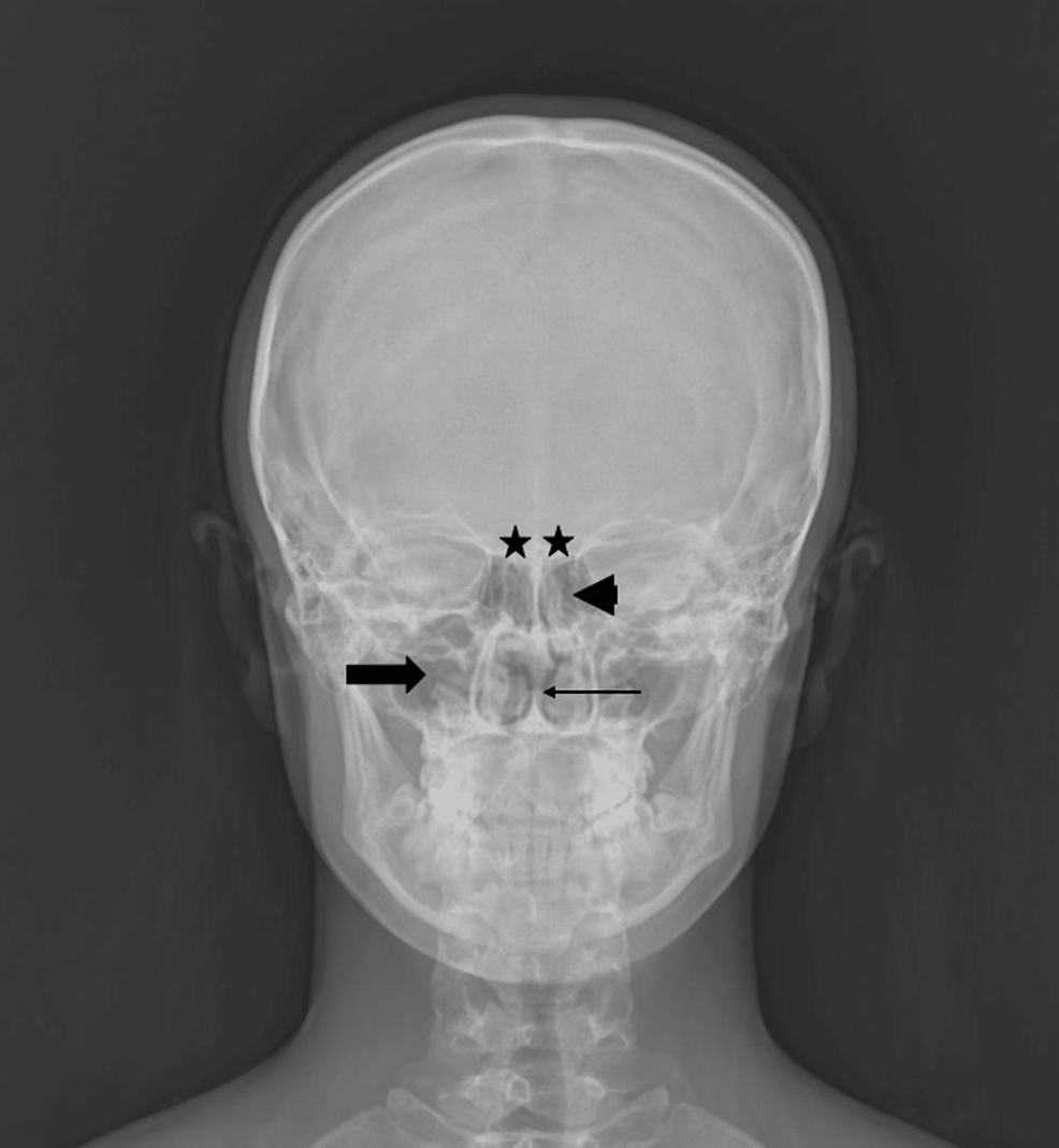 Sex Determination Using Frontal Sinus Diameters On Direct Radiography Cureus