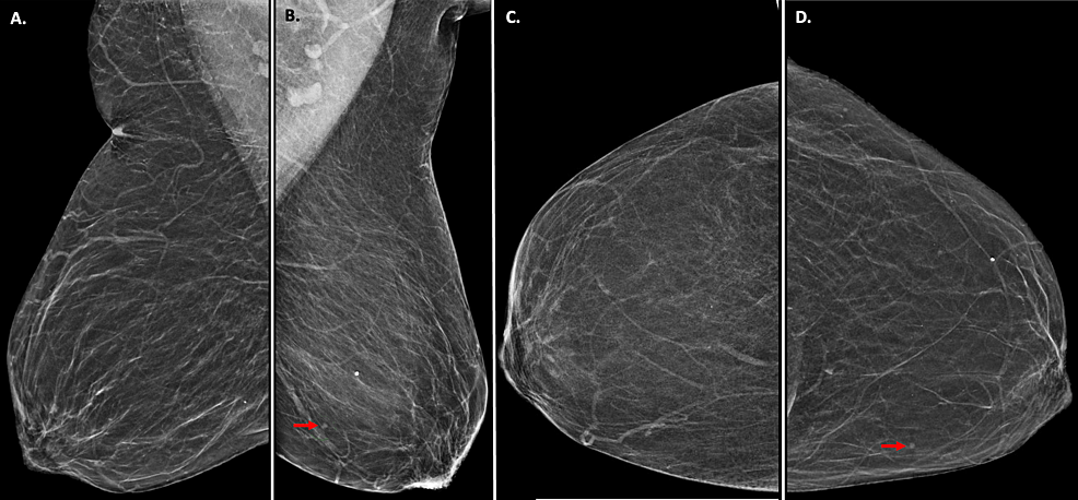 Cureus, Clinically Silent, Metastatic Renal Cell Carcinoma Detected on Routine  Screening Mammogram: A Report of a Rare Case and Review of Literature