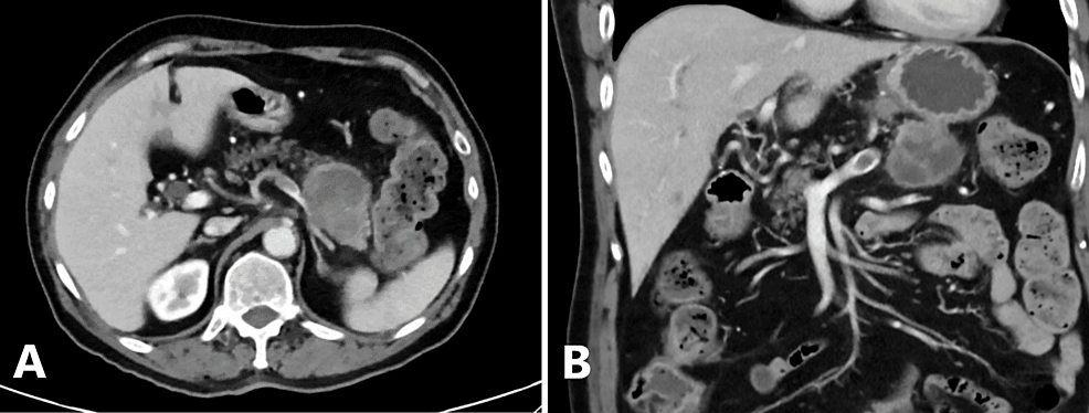 A Rare Case of Rhabdoid Pancreatic Carcinoma: Prolonged Disease-Free Survival Following Upfront Resection and Adjuvant Chemotherapy