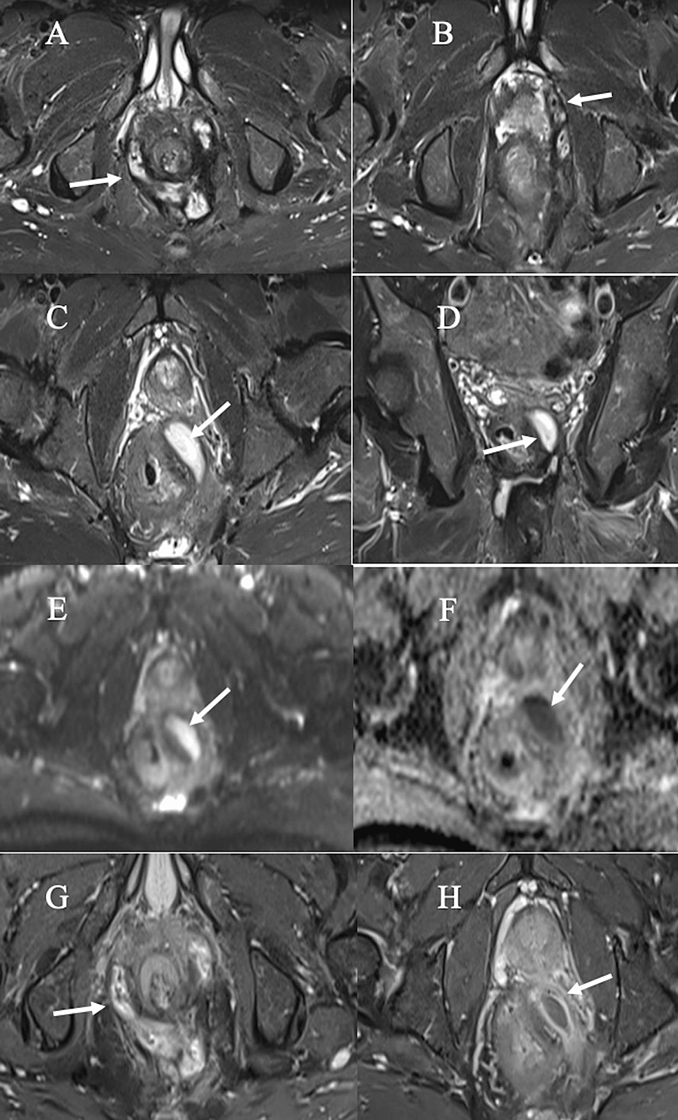 Cureus Comparing the Efficacy of a Combination of DiffusionWeighted