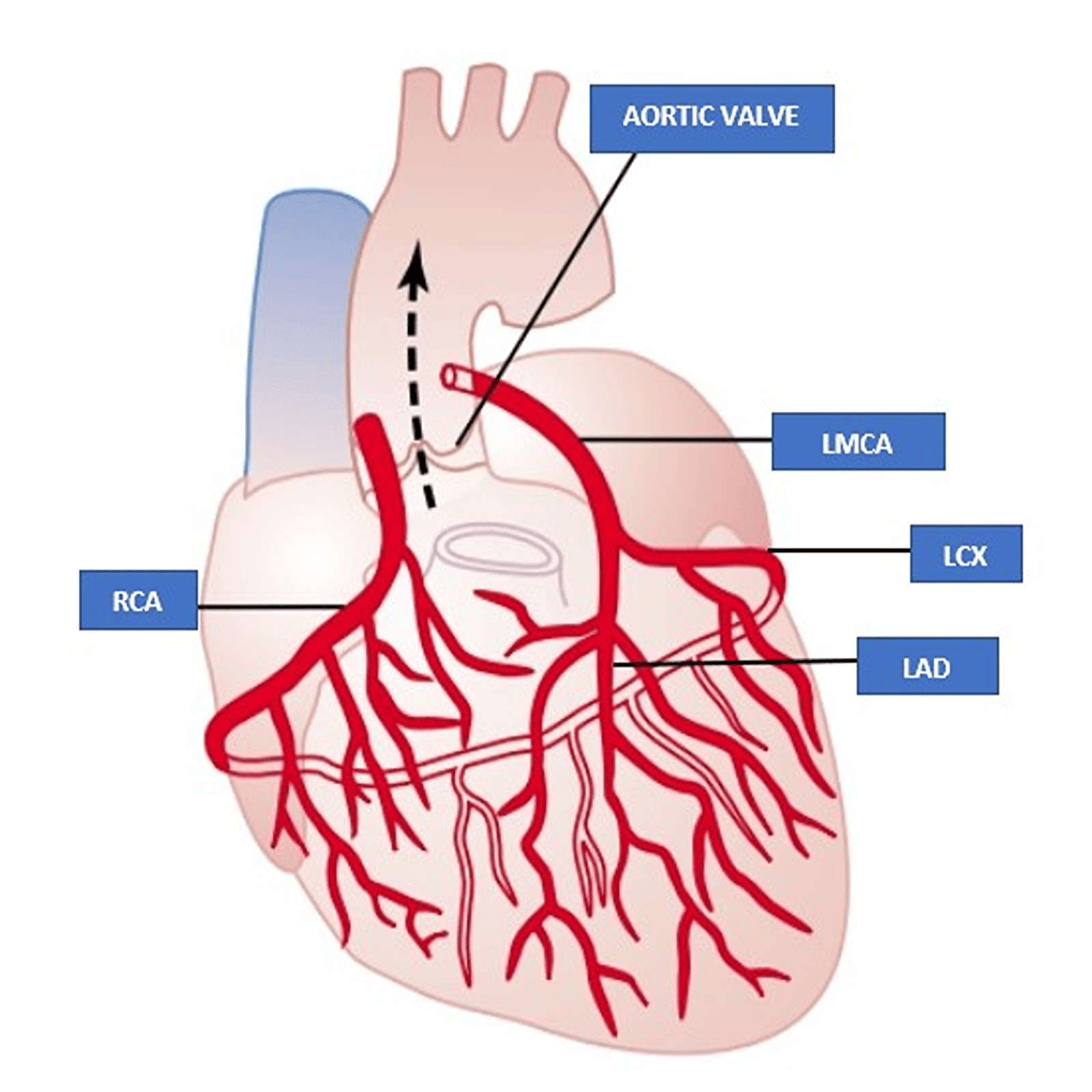 A Single Coronary Artery From the Left Coronary Sinus The Continuing