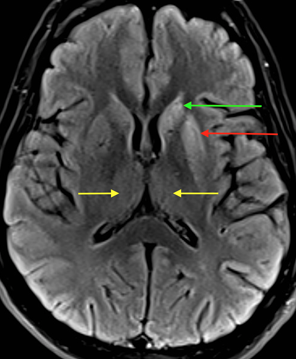 Cureus CreutzfeldtJakob Disease Presenting with Abducens Nerve Palsy