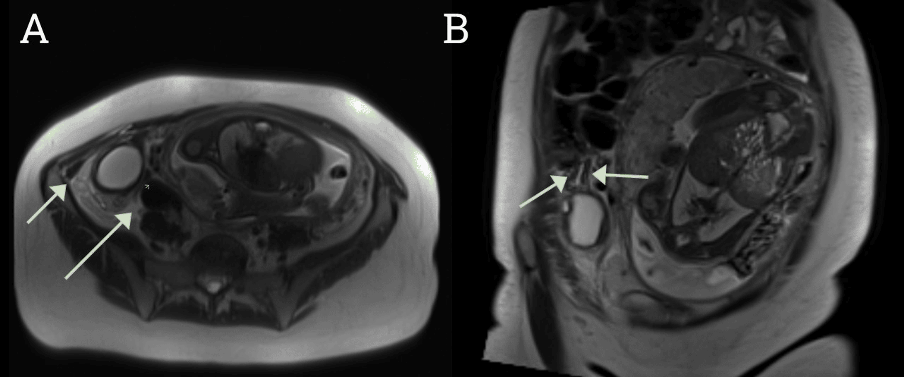 Cureus | Concomitant Paratubal Cyst and Isolated Fallopian Tube Torsion ...