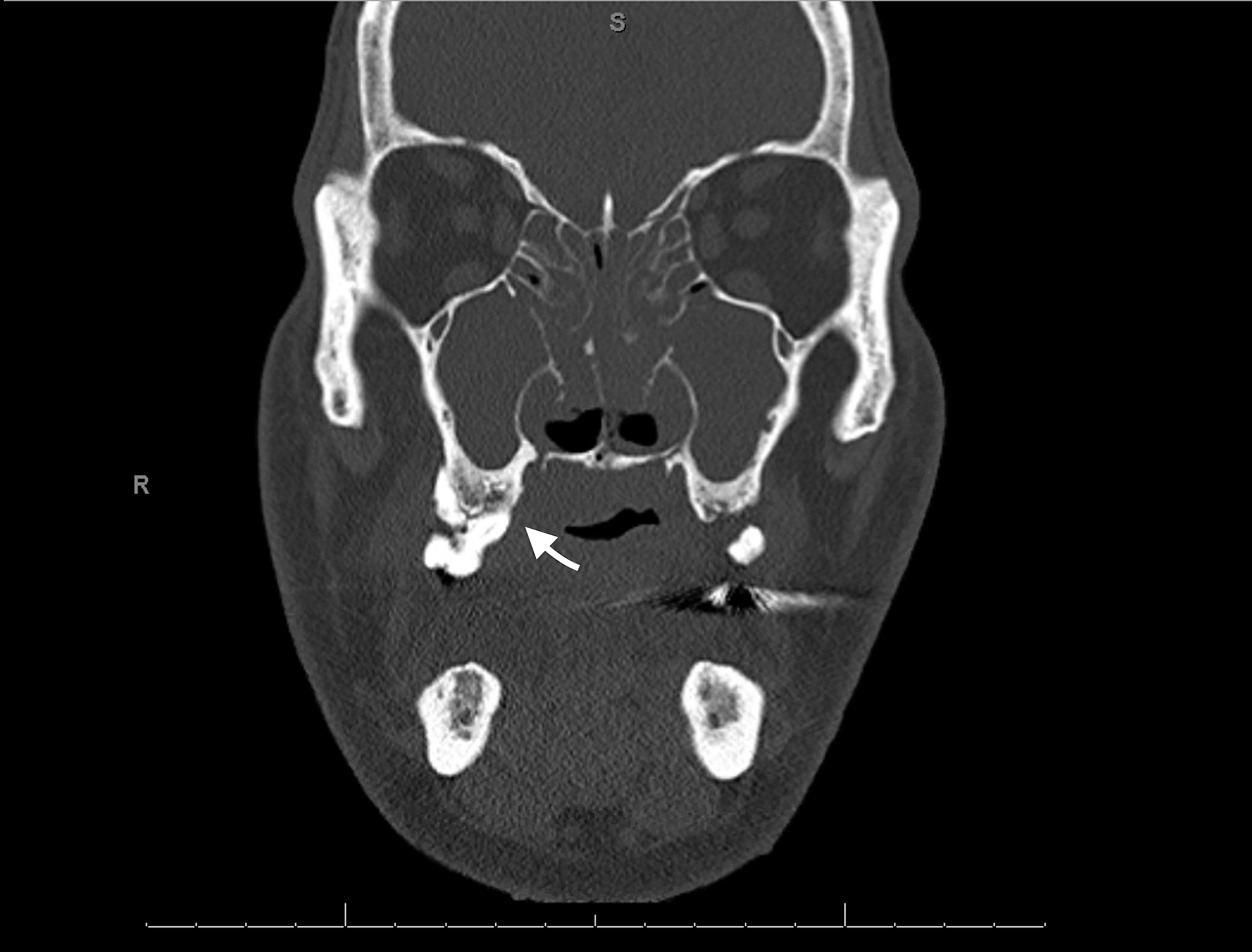 Cureus Maxillary Osteomyelitis in a Patient with Pansinusitis and