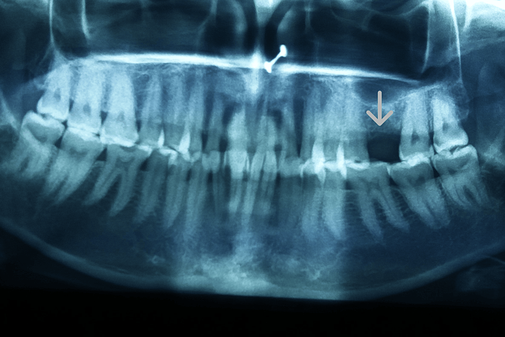 Cureus | A Case Report of Atraumatic Tooth Extraction Followed by Ridge ...