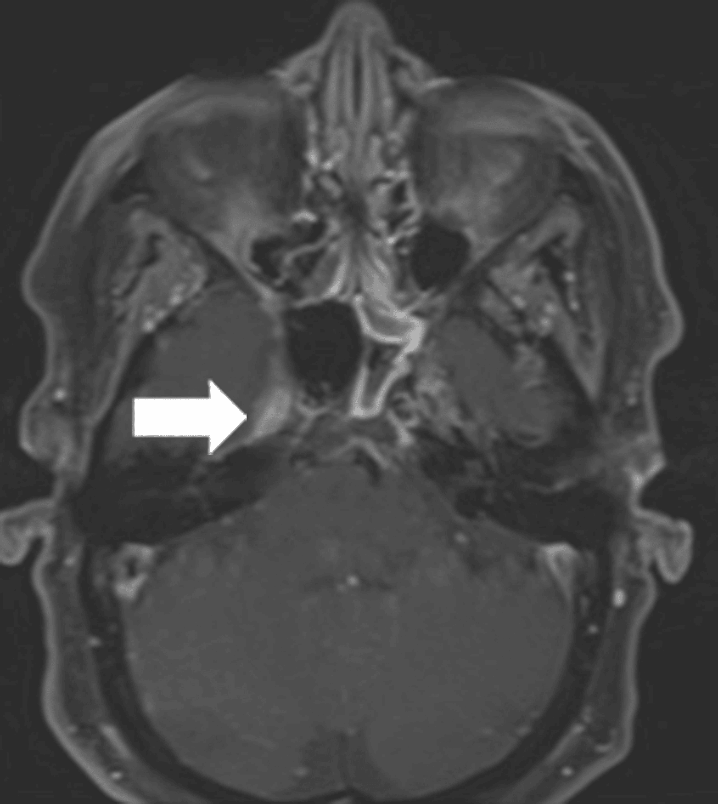 Cureus | Navigating Complexities in Pediatric Rhabdomyosarcoma: A Case 