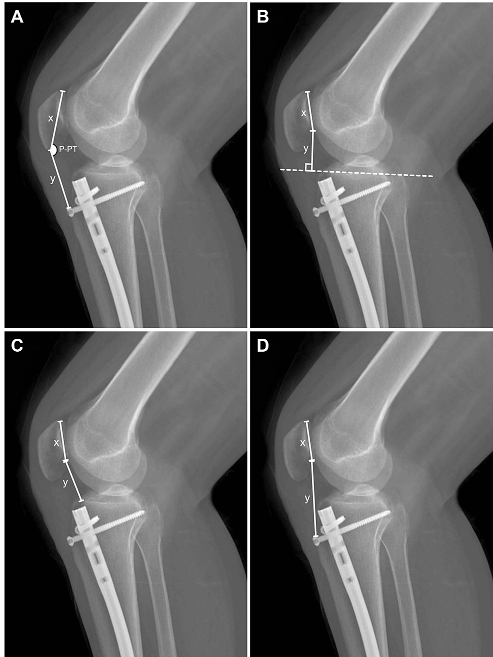 Fixation of Distal Tibial Fractures by Intramedullary Nail with  Multidirectional Distal Locking Screws