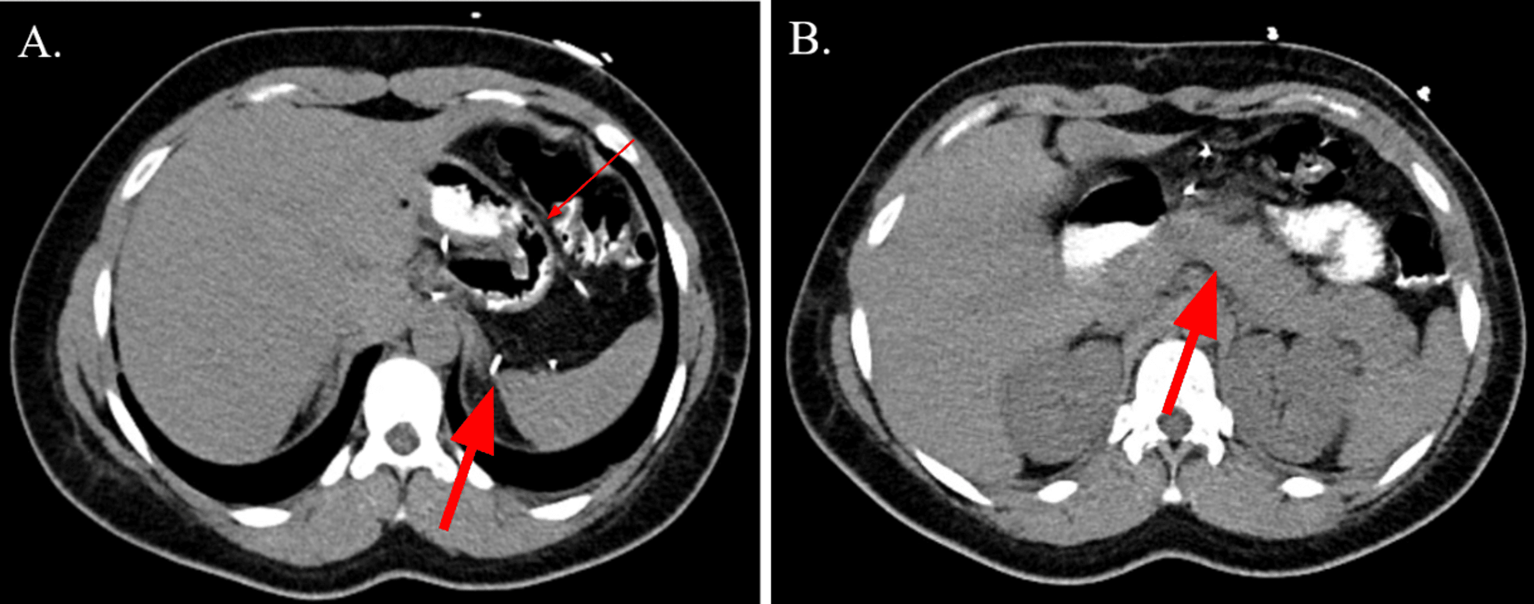 Postoperative Stomach Volvulus and Pancreatitis Following a Sleeve Gastrectomy Cureus