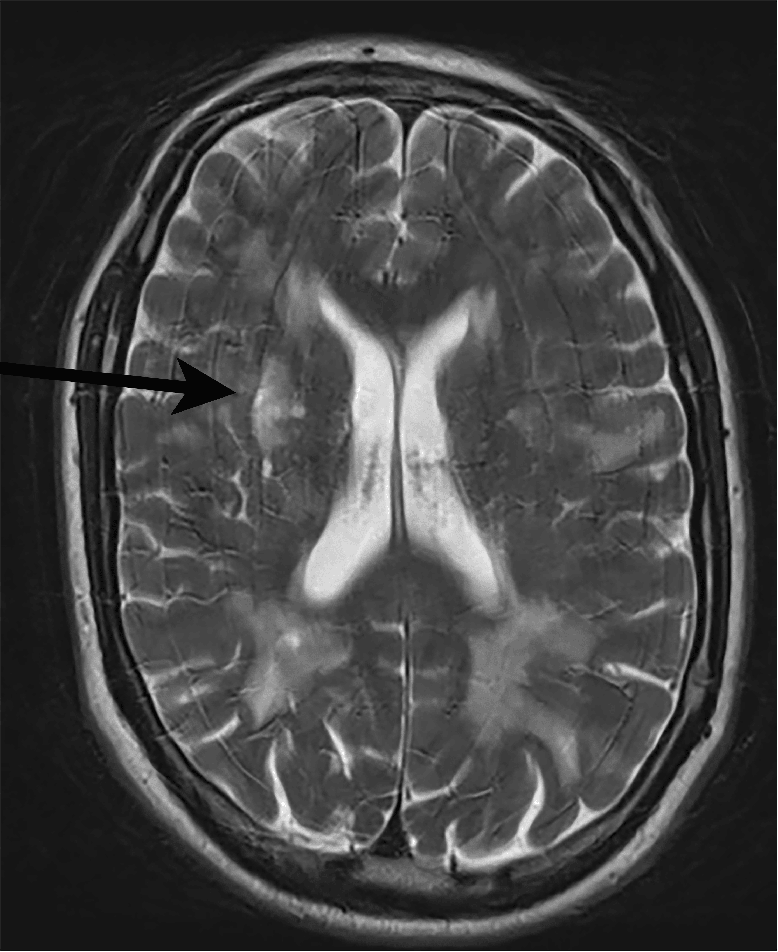 Cerebral Autosomal Dominant Arteriopathy With Subcortical Infarcts and